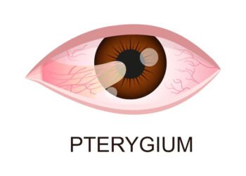 What is Pterygium and How is it Treated?