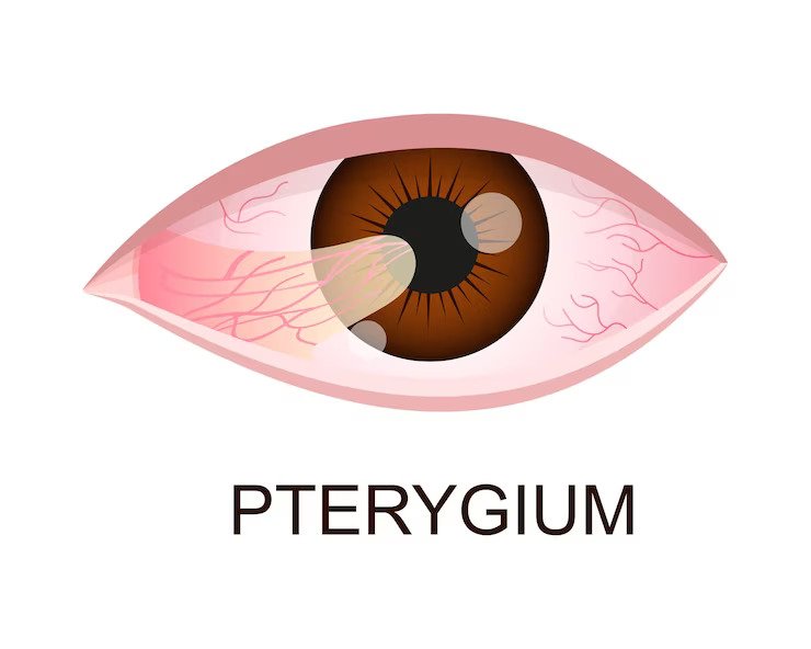 What Is Pterygium And How Is It Treated?