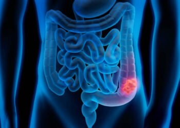 Colon Cancer Afflicts Younger Individuals