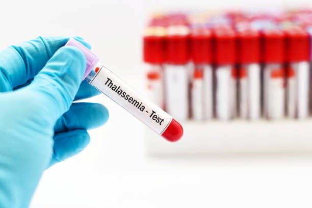 Understanding Thalassemia: Causes, Treatment, and the Importance of Awareness