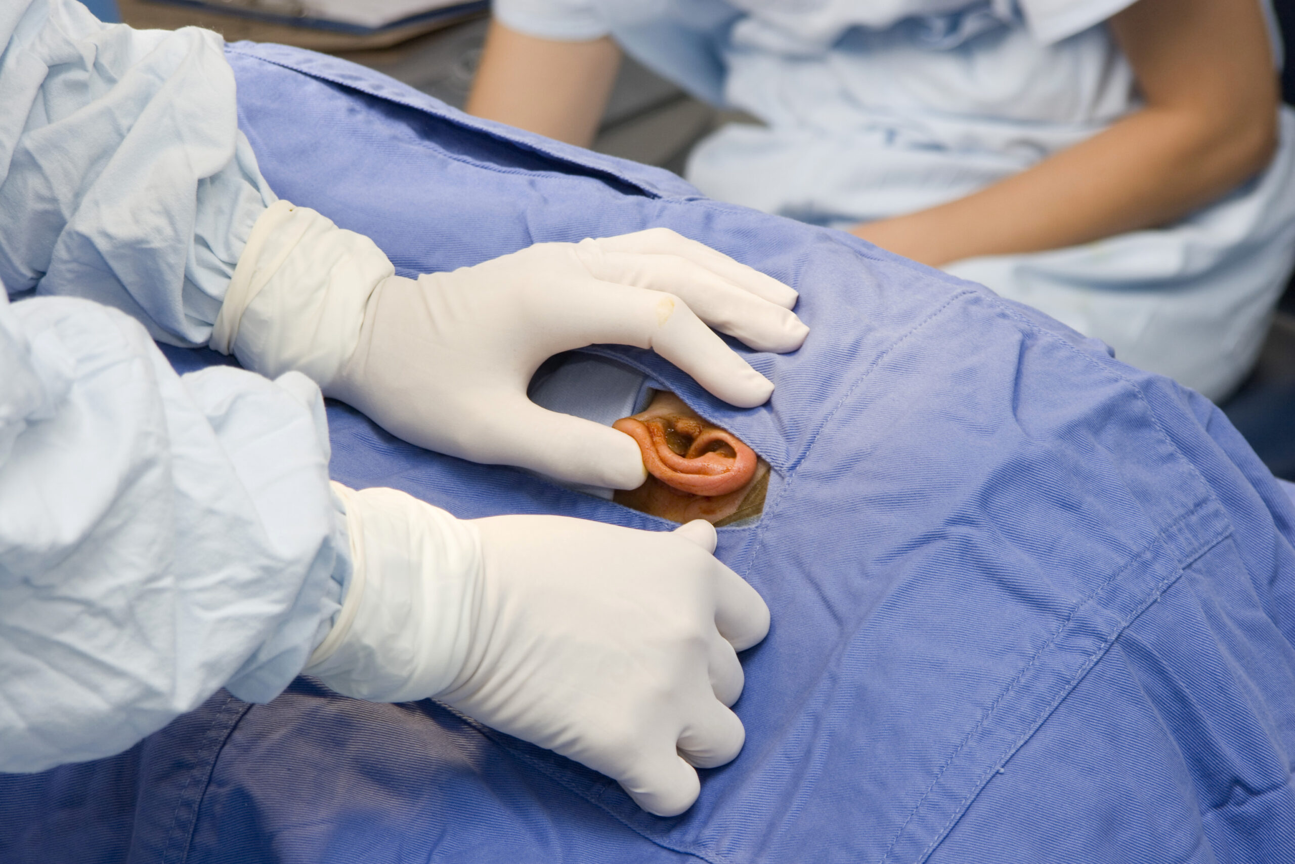 70-Year-Old Man's Eardrum Repaired Without Scar at Wockhardt Hospitals 1 70-Year-Old Man's Eardrum Repaired Without Scar at Wockhardt Hospitals