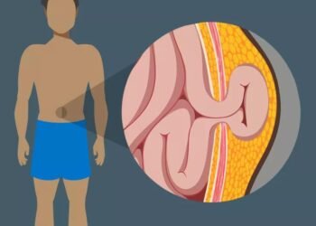 Ways to Fix a Hernia without Surgery