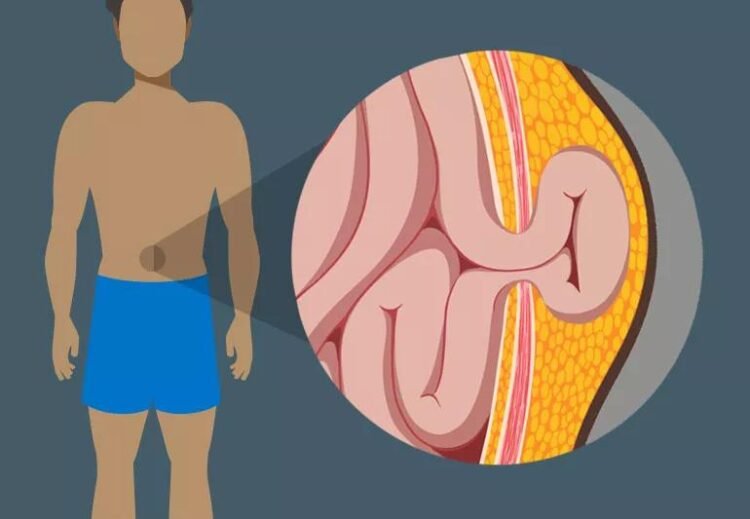 Ways to Fix a Hernia without Surgery