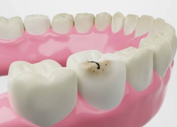 Understanding Tooth Decay: Causes, Prevention, and Treatment