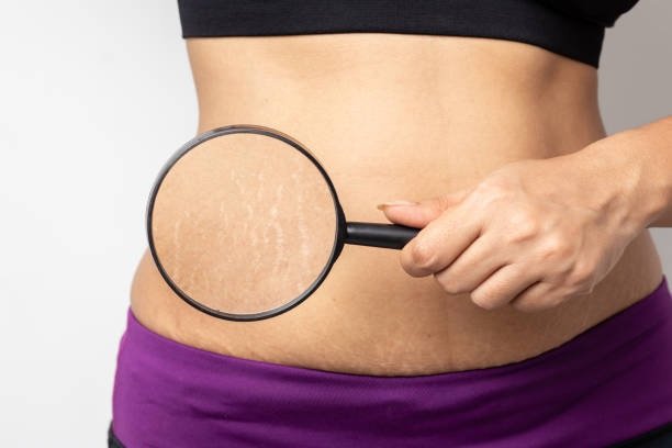 Pregnancy Stretch Marks istock