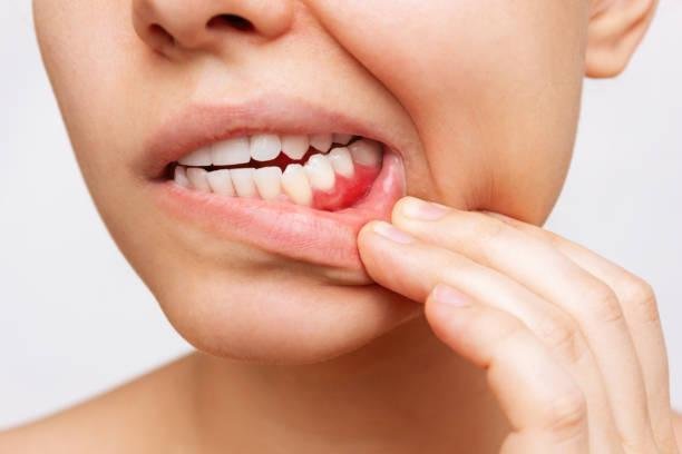 How To Treat and Prevent Painful Gum and Mouth Infections