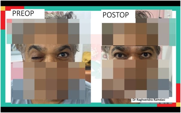 The Hidden Neurological Emergency Behind a Simple Eyelid Droop, A Case in Pituitary Apoplexy with Third Nerve Palsy