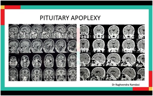 The Hidden Neurological Emergency Behind a Simple Eyelid Droop, A Case in Pituitary Apoplexy with Third Nerve Palsy