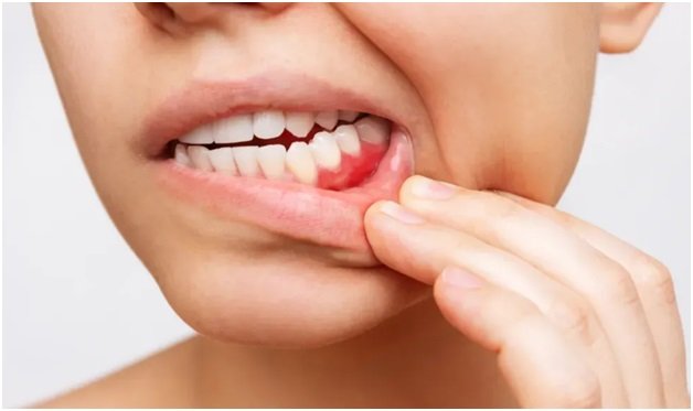 How Mouth Cancer Symptoms Progress from Early to Late Stages