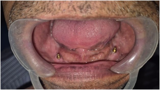 Teeth Care Multispeciality Dental Clinic Emerges as the Best Dental Implant Supported Denture Clinic in Kolkata 1 Teeth Care Multispeciality Dental Clinic